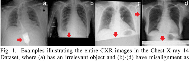 Figure 1 for SDFN: Segmentation-based Deep Fusion Network for Thoracic Disease Classification in Chest X-ray Images