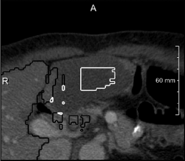 Figure 1 for Neural Network-Based Automatic Liver Tumor Segmentation With Random Forest-Based Candidate Filtering