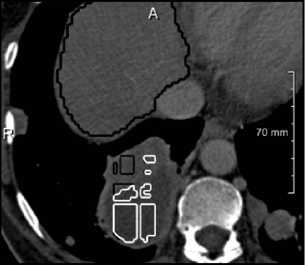 Figure 2 for Neural Network-Based Automatic Liver Tumor Segmentation With Random Forest-Based Candidate Filtering