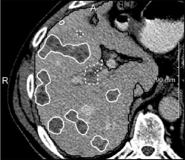 Figure 4 for Neural Network-Based Automatic Liver Tumor Segmentation With Random Forest-Based Candidate Filtering