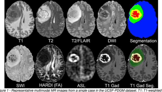 Figure 2 for The University of California San Francisco Preoperative Diffuse Glioma  MRI Dataset