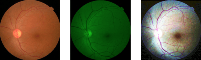 Figure 2 for Classification of Diabetic Retinopathy Severity in Fundus Images with DenseNet121 and ResNet50