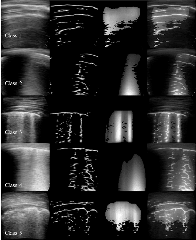 Figure 4 for An Approach Towards Physics Informed Lung Ultrasound Image Scoring Neural Network for Diagnostic Assistance in COVID-19