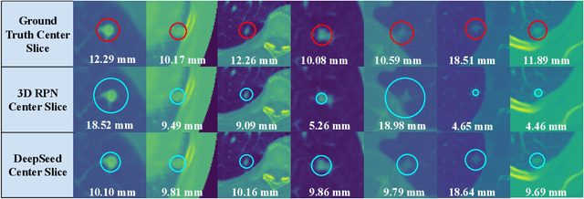Figure 3 for DeepSEED: 3D Squeeze-and-Excitation Encoder-Decoder ConvNets for Pulmonary Nodule Detection