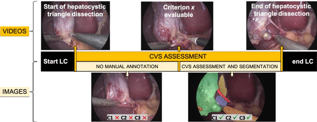 Figure 3 for Surgical data science for safe cholecystectomy: a protocol for segmentation of hepatocystic anatomy and assessment of the critical view of safety
