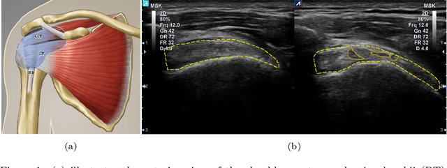 Figure 1 for Automatic Recognition of the Supraspinatus Tendinopathy from Ultrasound Images using Convolutional Neural Networks