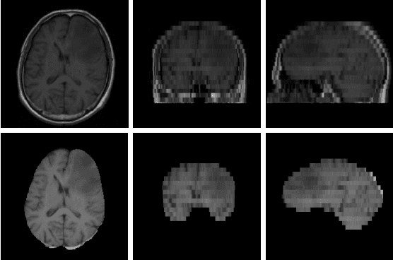 Figure 1 for Skull-stripping for Tumor-bearing Brain Images