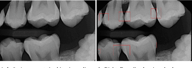 Figure 1 for Detection of Tooth caries in Bitewing Radiographs using Deep Learning