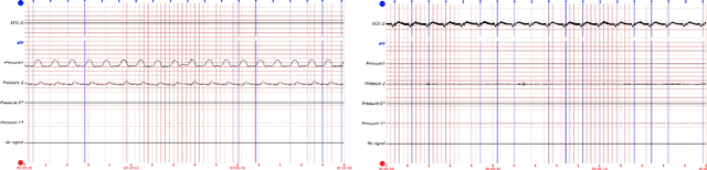 Figure 1 for Probabilistic Model-Based Approach for Heart Beat Detection