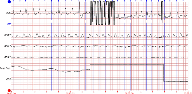 Figure 2 for Probabilistic Model-Based Approach for Heart Beat Detection