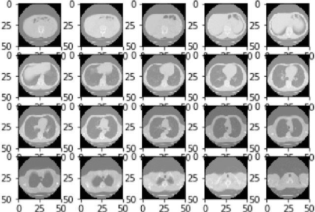 Figure 2 for Deep Expectation-Maximization for Semi-Supervised Lung Cancer Screening