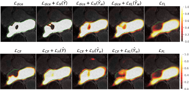 Figure 1 for Maximum Entropy on Erroneous Predictions (MEEP): Improving model calibration for medical image segmentation