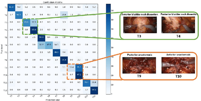 Figure 4 for Surgical Activity Recognition in Robot-Assisted Radical Prostatectomy using Deep Learning