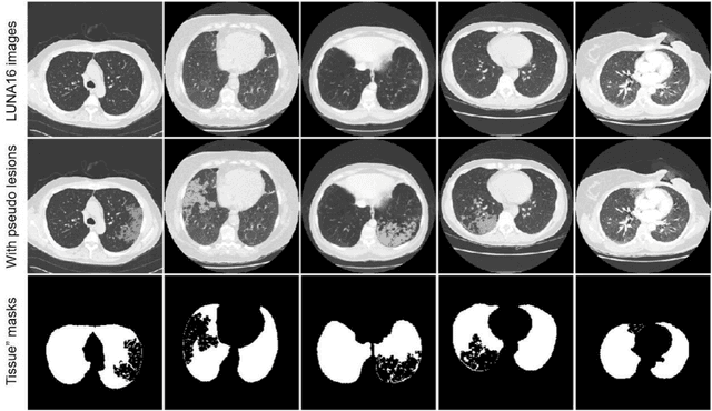 Figure 3 for Automated assessment of disease severity of COVID-19 using artificial intelligence with synthetic chest CT