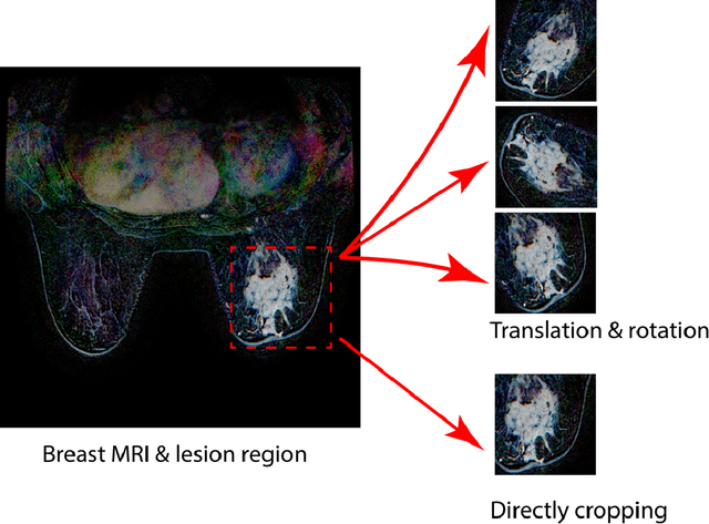 Figure 3 for Deep learning analysis of breast MRIs for prediction of occult invasive disease in ductal carcinoma in situ