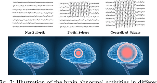 Figure 2 for QuPWM: Feature Extraction Method for MEG Epileptic Spike Detection