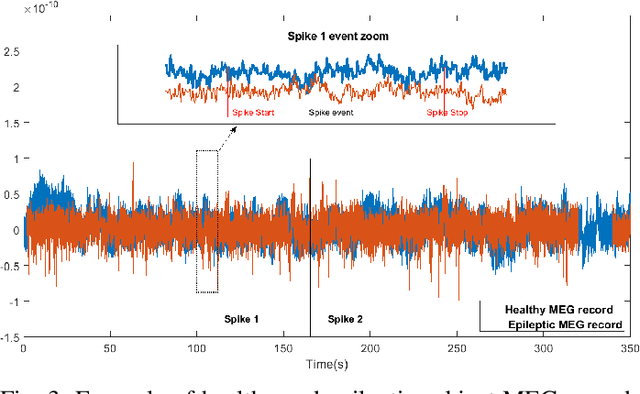 Figure 3 for QuPWM: Feature Extraction Method for MEG Epileptic Spike Detection