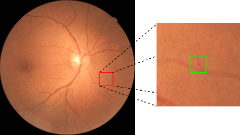 Figure 1 for Mini Lesions Detection on Diabetic Retinopathy Images via Large Scale CNN Features