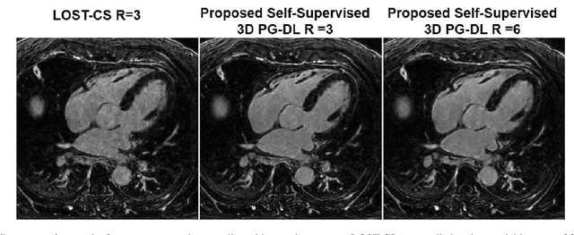 Figure 2 for Self-Supervised Physics-Guided Deep Learning Reconstruction For High-Resolution 3D LGE CMR