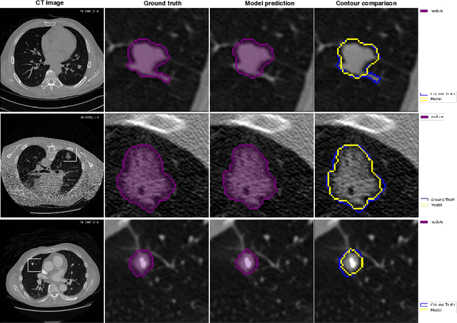 Figure 4 for NoduleNet: Decoupled False Positive Reductionfor Pulmonary Nodule Detection and Segmentation