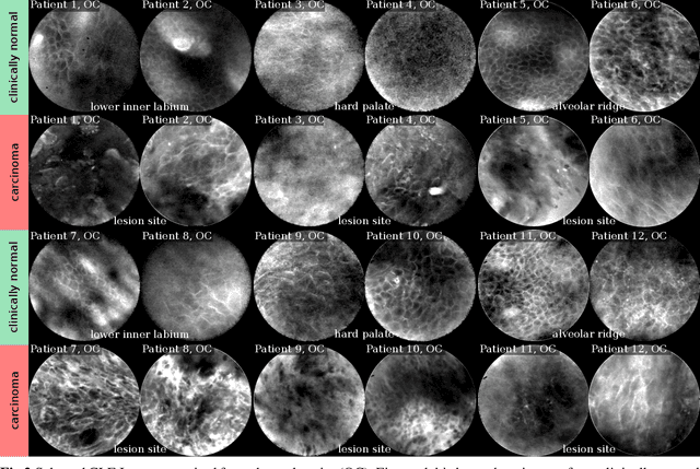Figure 3 for Transferability of Deep Learning Algorithms for Malignancy Detection in Confocal Laser Endomicroscopy Images from Different Anatomical Locations of the Upper Gastrointestinal Tract