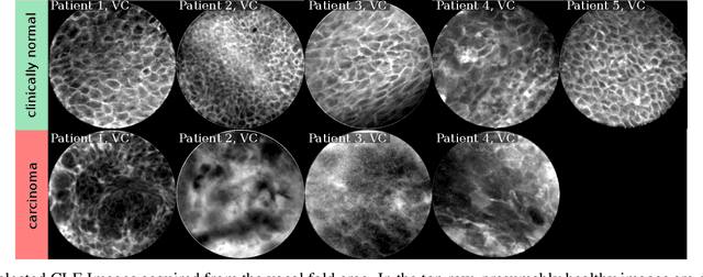 Figure 4 for Transferability of Deep Learning Algorithms for Malignancy Detection in Confocal Laser Endomicroscopy Images from Different Anatomical Locations of the Upper Gastrointestinal Tract