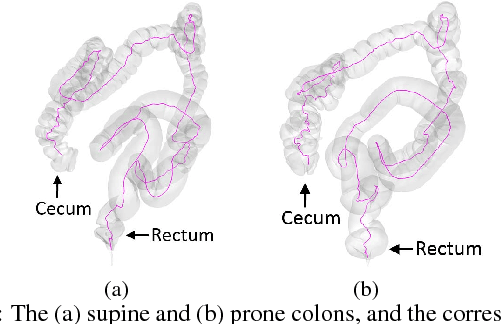Figure 4 for C2A: Crowd Consensus Analytics for Virtual Colonoscopy