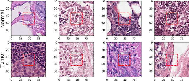 Figure 1 for Using convolutional neural networks for the classification of breast cancer images