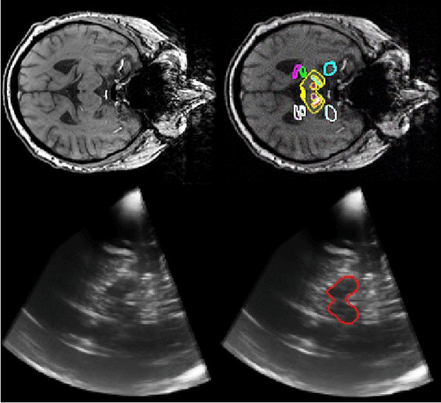 Figure 1 for Hough-CNN: Deep Learning for Segmentation of Deep Brain Regions in MRI and Ultrasound