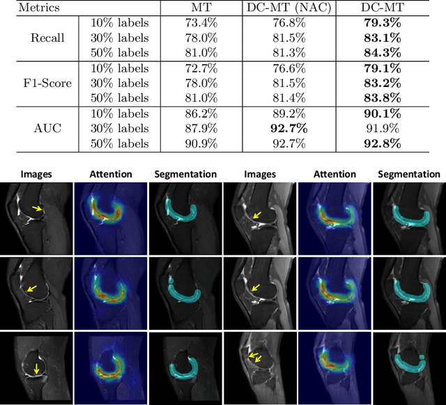 Figure 4 for A Self-ensembling Framework for Semi-supervised Knee Osteoarthritis Localization and Classification with Dual-Consistency