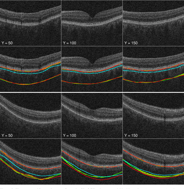 Figure 4 for Automated segmentation of choroidal layers from 3-dimensional macular optical coherence tomography scans