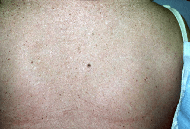 Figure 1 for Can self-training identify suspicious ugly duckling lesions?