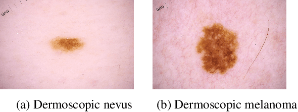 Figure 2 for Can self-training identify suspicious ugly duckling lesions?