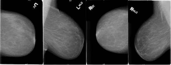 Figure 2 for Abnormality Detection in Mammography using Deep Convolutional Neural Networks