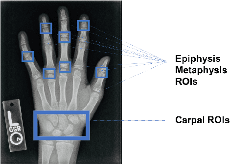 Figure 1 for A Deep Framework for Bone Age Assessment based on Finger Joint Localization