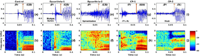 Figure 1 for Consonant-Vowel Transition Models Based on Deep Learning for Objective Evaluation of Articulation