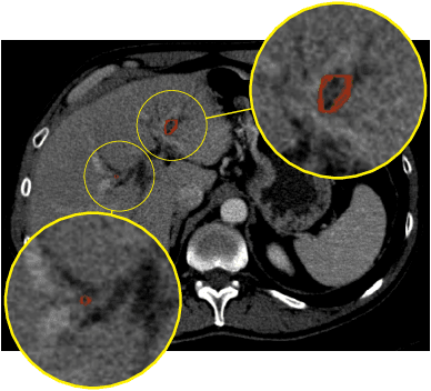 Figure 4 for Hybrid Cascaded Neural Network for Liver Lesion Segmentation