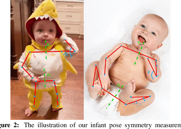 Figure 3 for Computer Vision to the Rescue: Infant Postural Symmetry Estimation from Incongruent Annotations