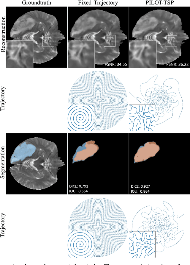 Figure 1 for PILOT: Physics-Informed Learned Optimal Trajectories for Accelerated MRI