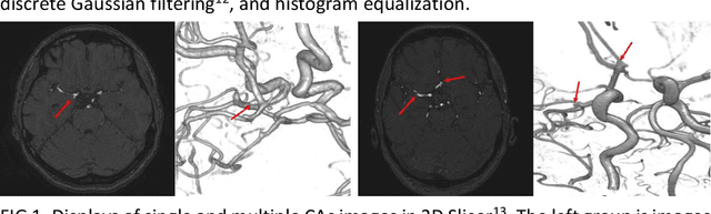 Figure 1 for Deep Learning-based Segmentation of Cerebral Aneurysms in 3D TOF-MRA using Coarse-to-Fine Framework