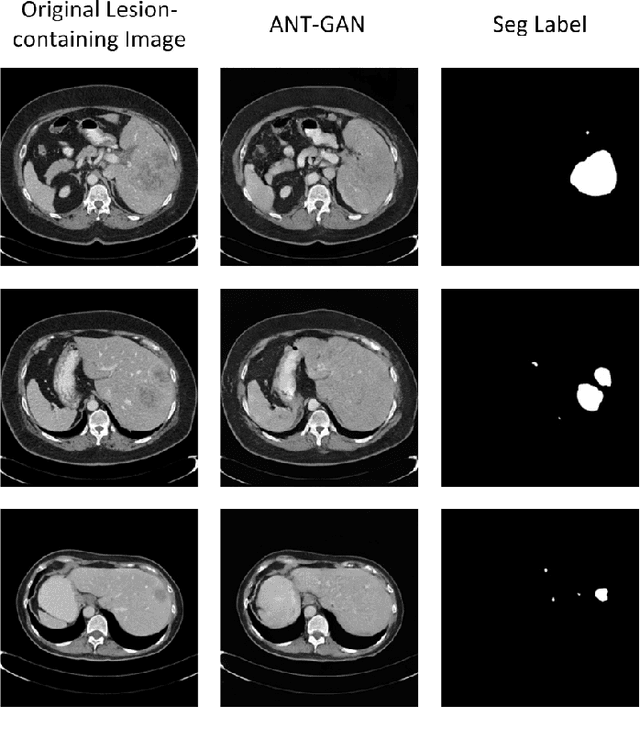 Figure 3 for An Adversarial Learning Approach to Medical Image Synthesis for Lesion Removal