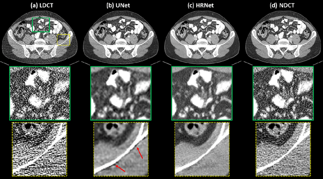 Figure 3 for Deep High-Resolution Network for Low Dose X-ray CT Denoising