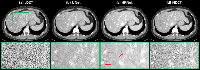Figure 4 for Deep High-Resolution Network for Low Dose X-ray CT Denoising