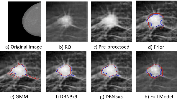 Figure 1 for Deep Structured learning for mass segmentation from Mammograms