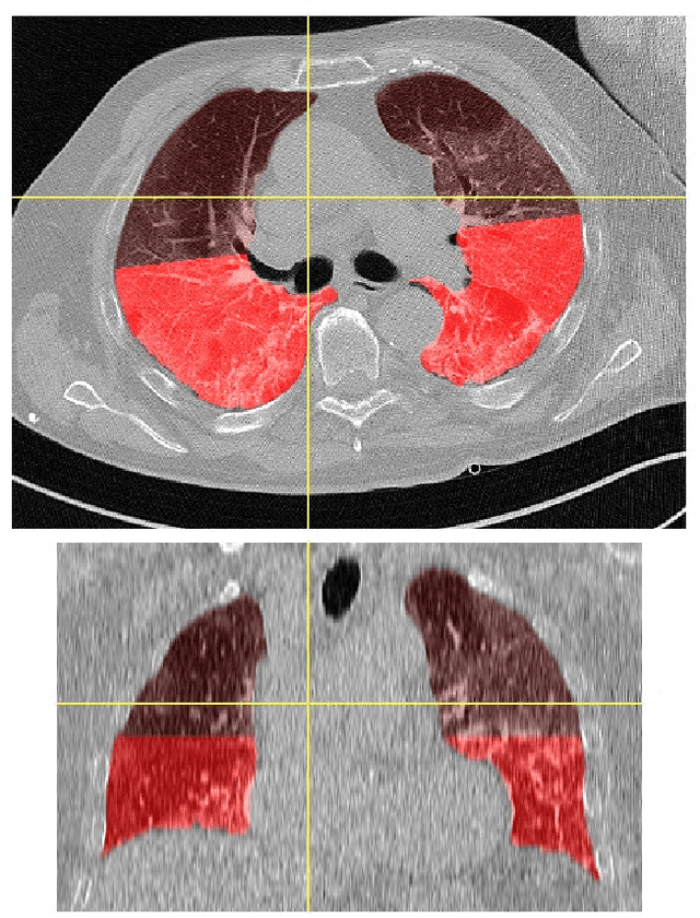 Figure 1 for A framework for quantitative analysis of Computed Tomography images of viral pneumonitis: radiomic features in COVID and non-COVID patients
