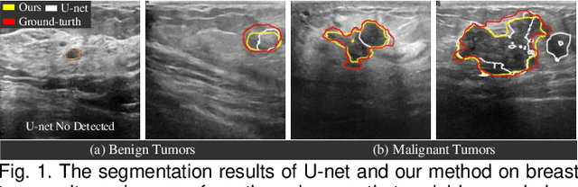 Figure 1 for NU-net: An Unpretentious Nested U-net for Breast Tumor Segmentation