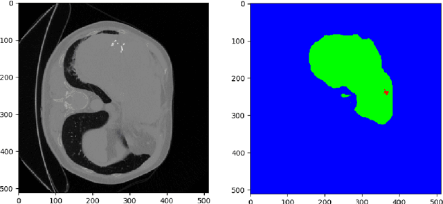 Figure 3 for A Joint Deep Learning Approach for Automated Liver and Tumor Segmentation