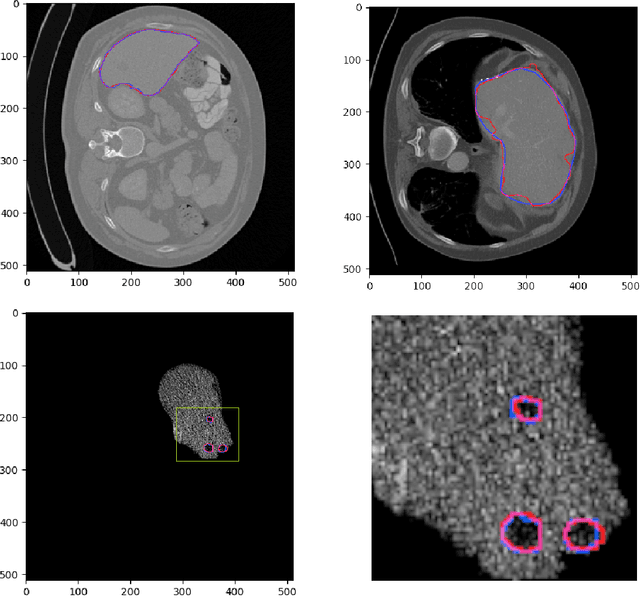 Figure 4 for A Joint Deep Learning Approach for Automated Liver and Tumor Segmentation