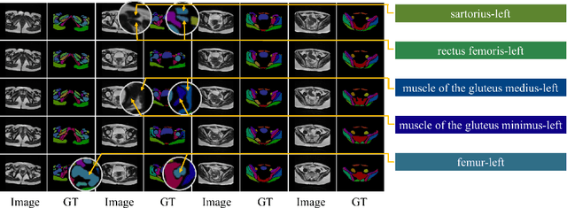 Figure 1 for Combining Pyramid Pooling and Attention Mechanism for Pelvic MR Image Semantic Segmentaion