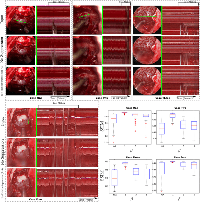 Figure 4 for Surgical Video Motion Magnification with Suppression of Instrument Artefacts